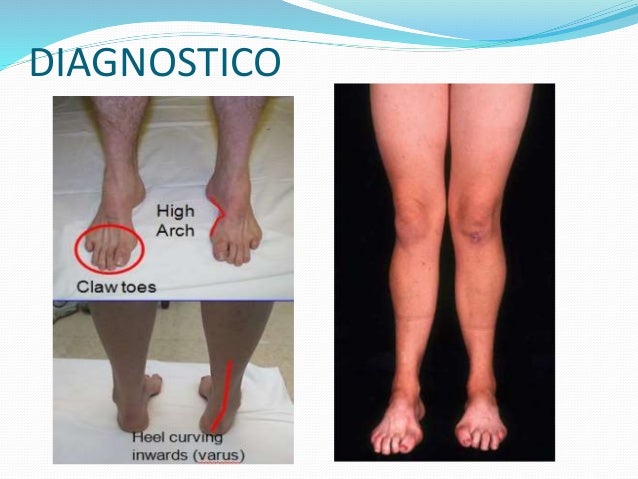 sindrome de charcot marie tooth